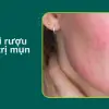 Tôi đã hối hận thế nào khi dùng rượu thuốc trị mụn?