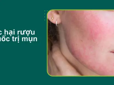 Tôi đã hối hận thế nào khi dùng rượu thuốc trị mụn?